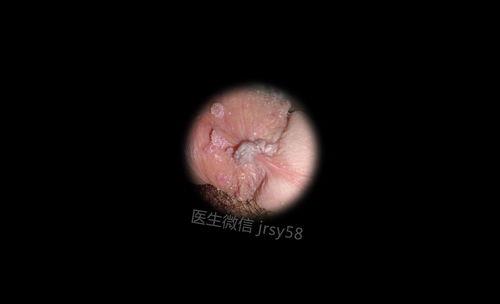湿疹会自己消失吗
