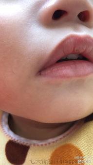 上火嘴角烂了怎么办