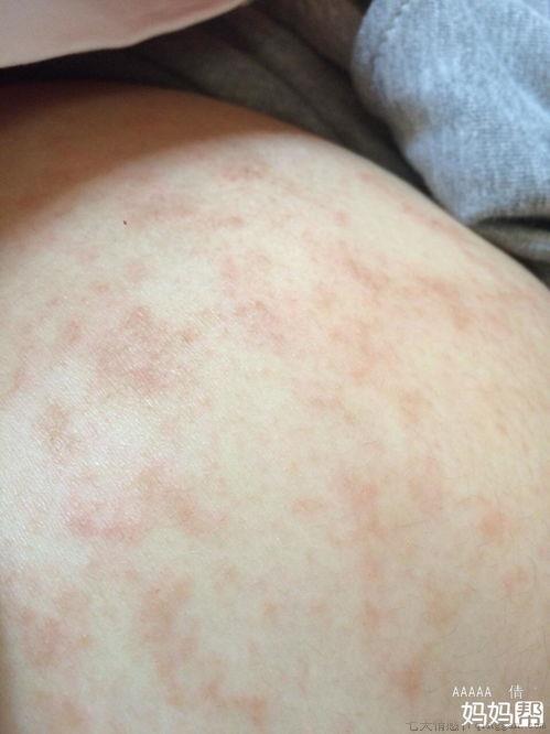 孕妇肚皮痒怎么办