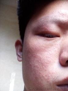 湿疹不治疗会自愈吗