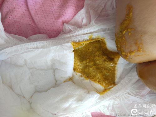 宝宝吃母乳拉稀怎么办