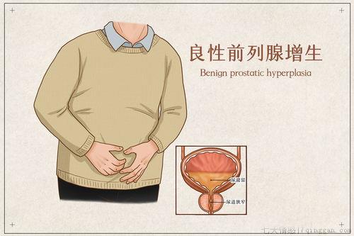 什么是良性前列腺增生