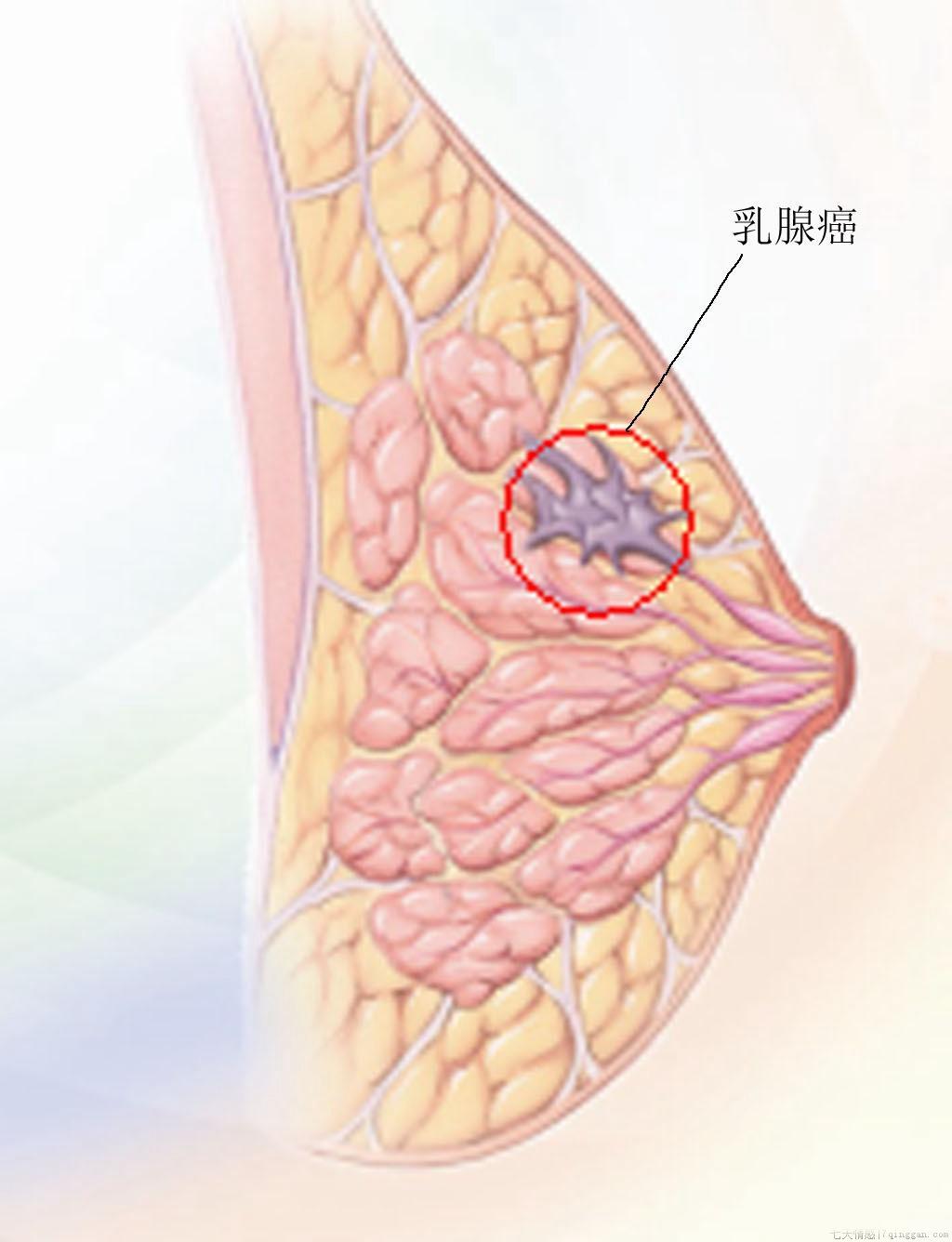 乳腺癌的症状有哪些