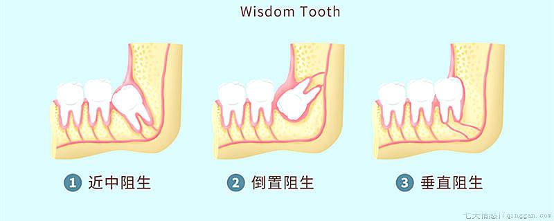 智齿一定要拔吗