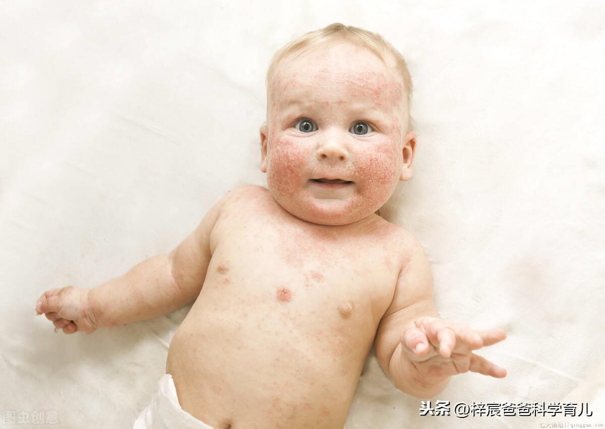 婴儿热疹和湿疹的区别