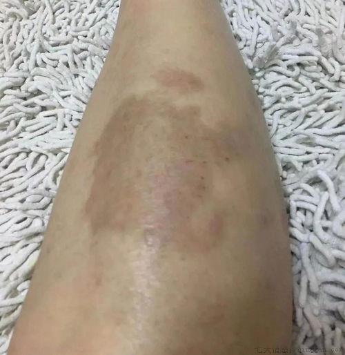 湿疹不治疗会自愈吗