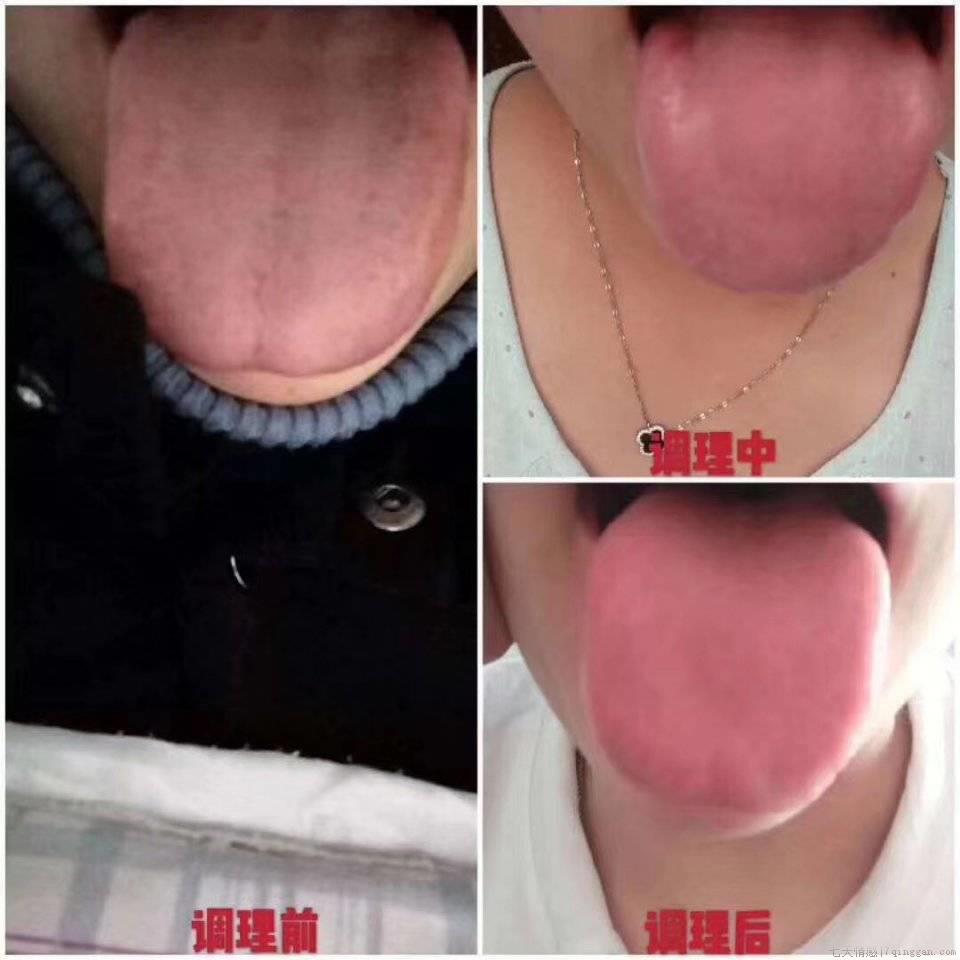 口臭口苦怎么办