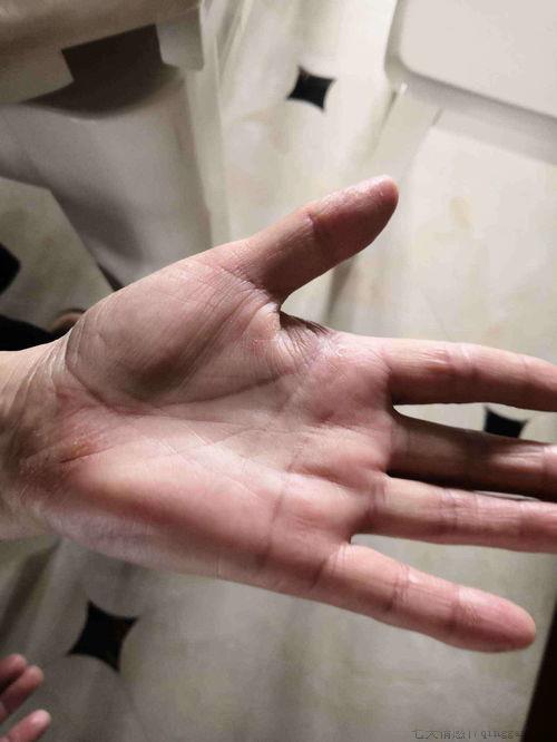 冬天手裂口子怎么办