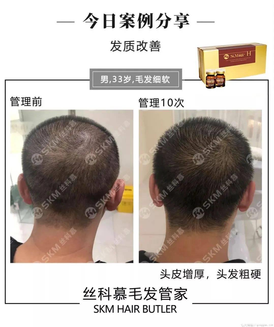 头发少又细怎么办