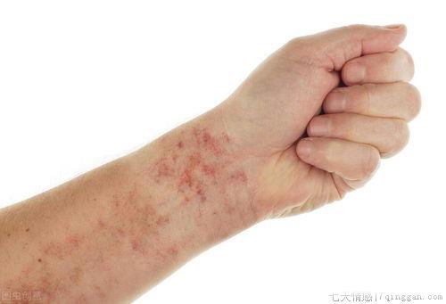 过敏性紫癜治疗方法