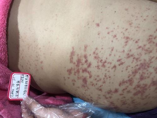 儿童过敏性紫癜容易反复吗