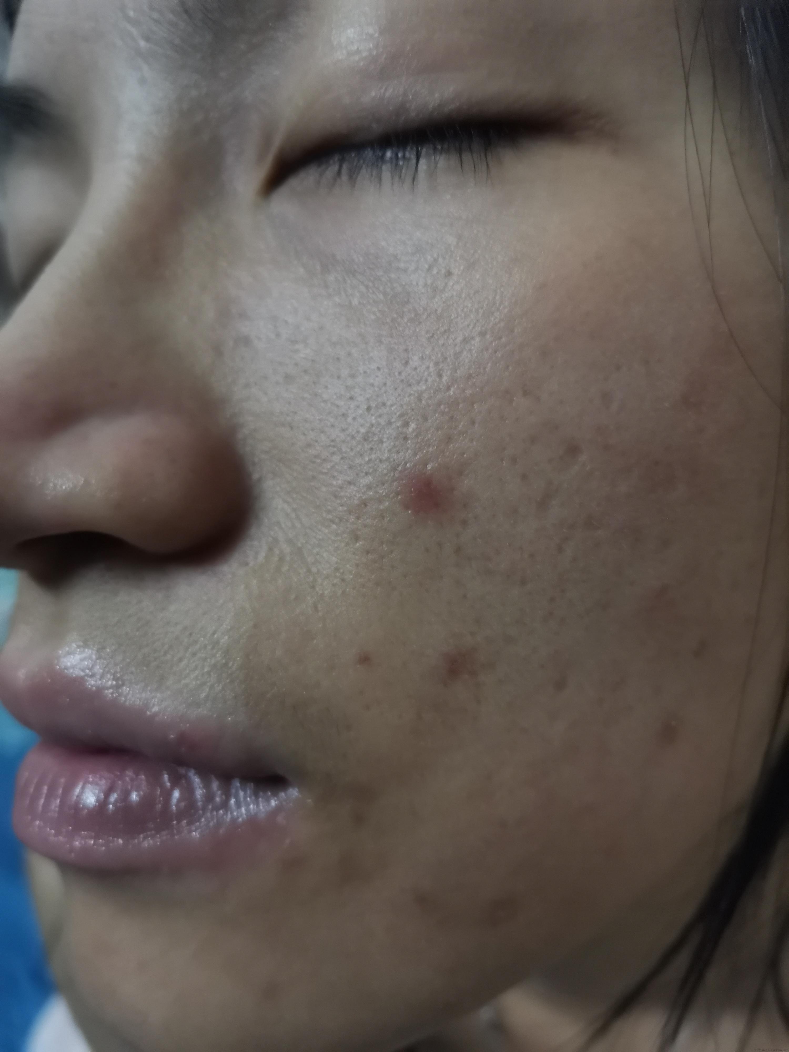 脸上起癣怎么办