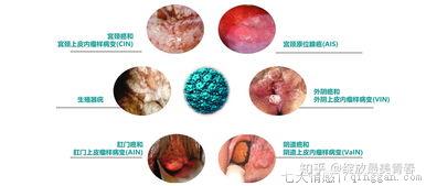 hpv是什么引起的