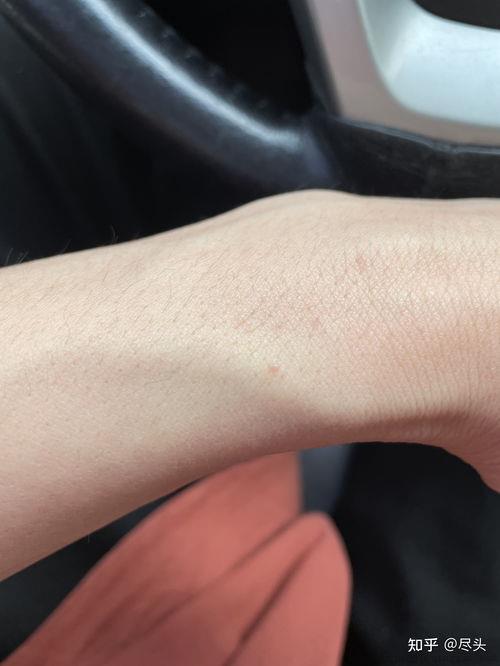 艾滋病hiv初期症状