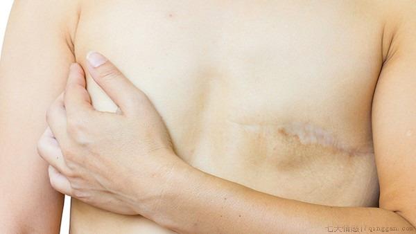 乳腺癌的分期标准及寿命