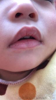 上火嘴角烂了怎么办