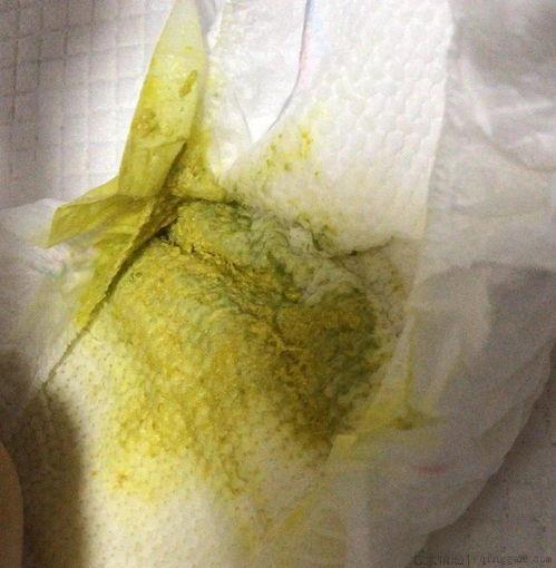 新生儿不拉大便怎么办