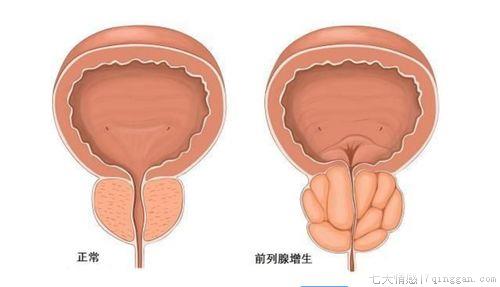 前列腺肥大怎么引起的