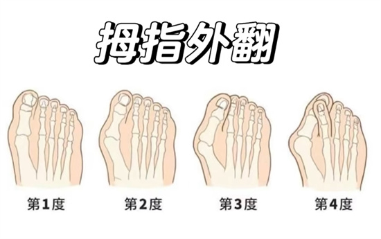拇指外翻是什么意思
