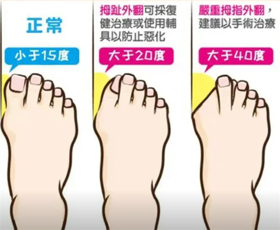 拇指外翻是什么意思 - 第1张