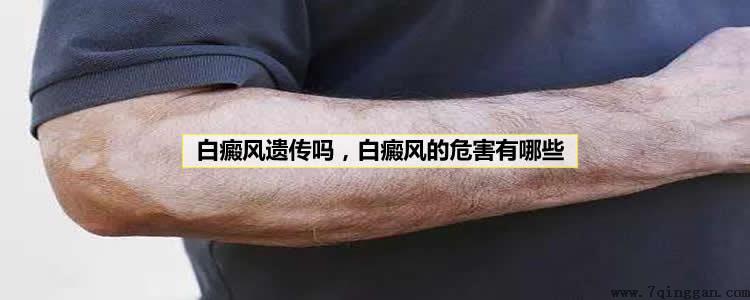 白癜风会遗传吗,白癜风的5大危害 白癜风会遗传吗,白癜风的5大危害
