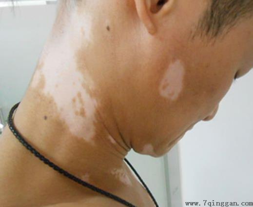 白癜风会遗传吗,白癜风的5大危害 白癜风会遗传吗,白癜风的5大危害