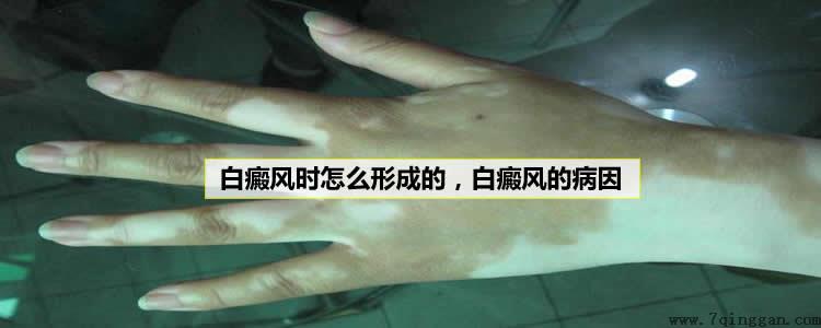 白癜风是怎么形成的,白癜风的病因 白癜风是怎么形成的,白癜风的病因