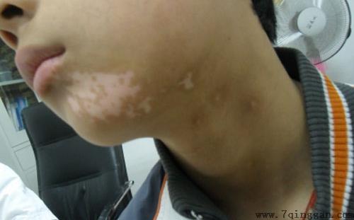 白癜风是怎么形成的,白癜风的病因 白癜风是怎么形成的,白癜风的病因