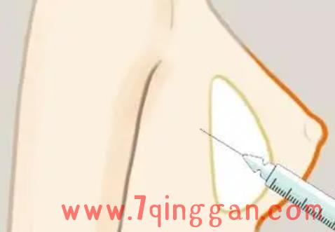 隆胸有哪几种方式